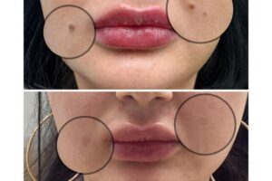 7D Hifu facial treatment