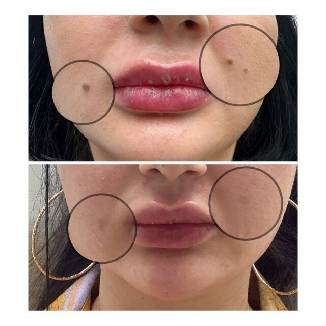 7D Hifu facial treatment